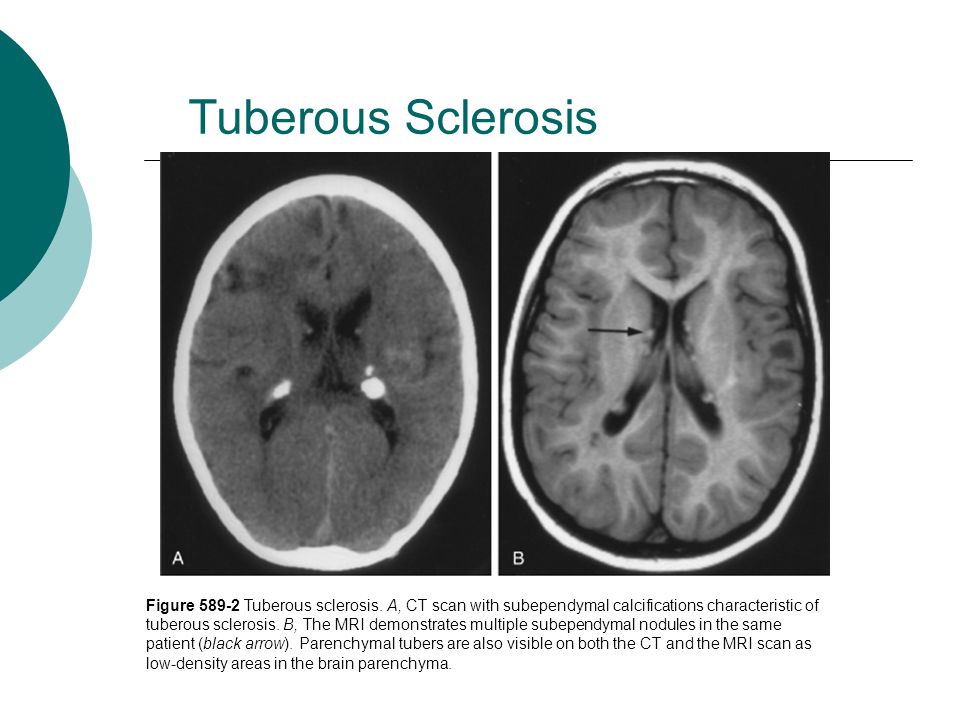 adult anxiety in sclerosis tuberous